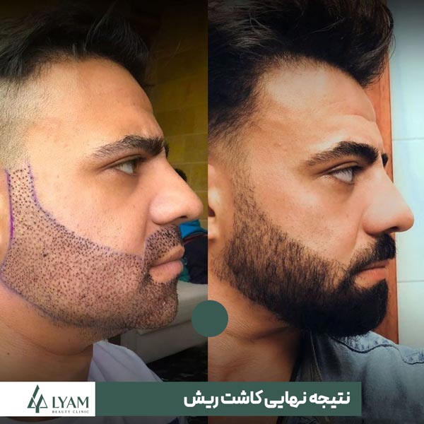 نتیجه کاشت ریش