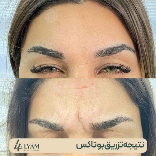 قبل و بعد از تزریق بوتاکس