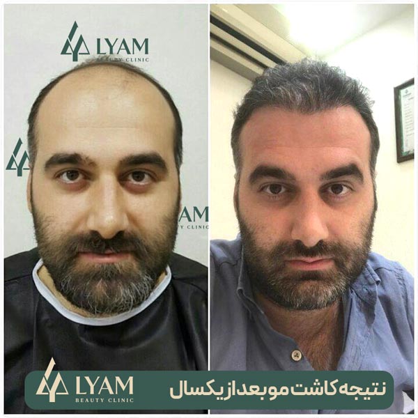 قبل و بعد از کاشت موی طبیعی