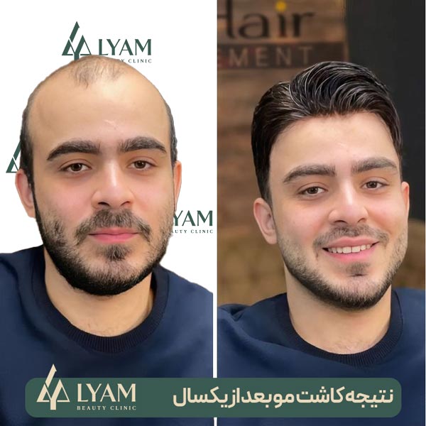 نتیجه کاشت مو کلینیک لیام