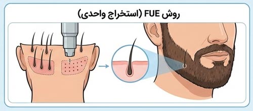 کاشت ریش به روش FUE