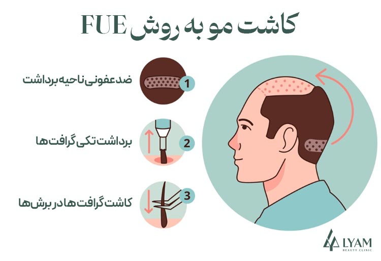مراحل کاشت مو به روش FUE