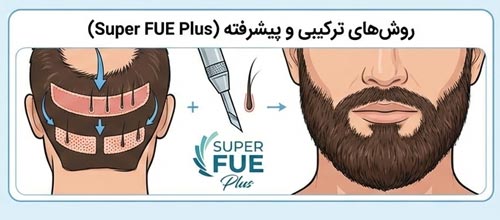 کاشت ریش مدرن و ترکیبی