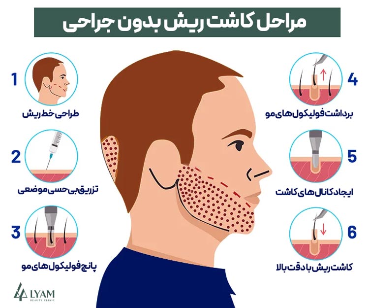 مراحل کاشت ریش