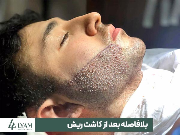 بلافاصله بعد از کاشت ریش