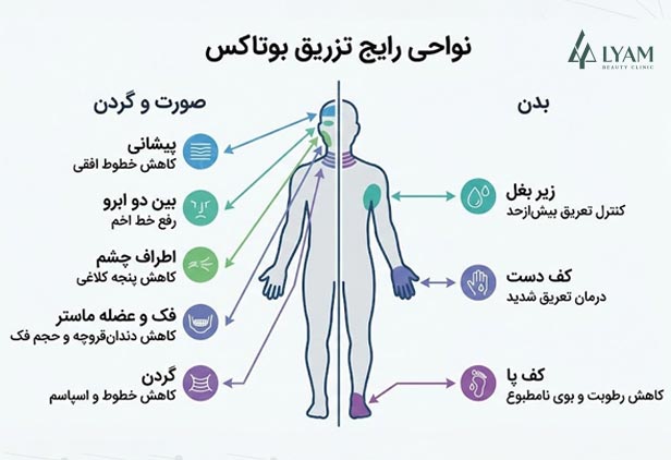 نواحی تزریق بوتاکس