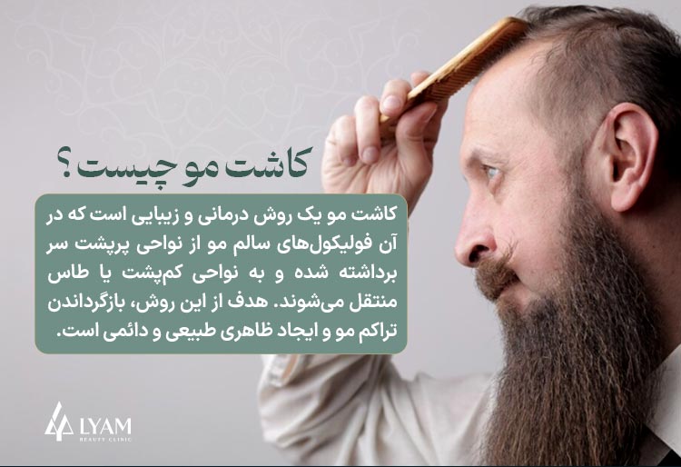 کاشت مو چیست