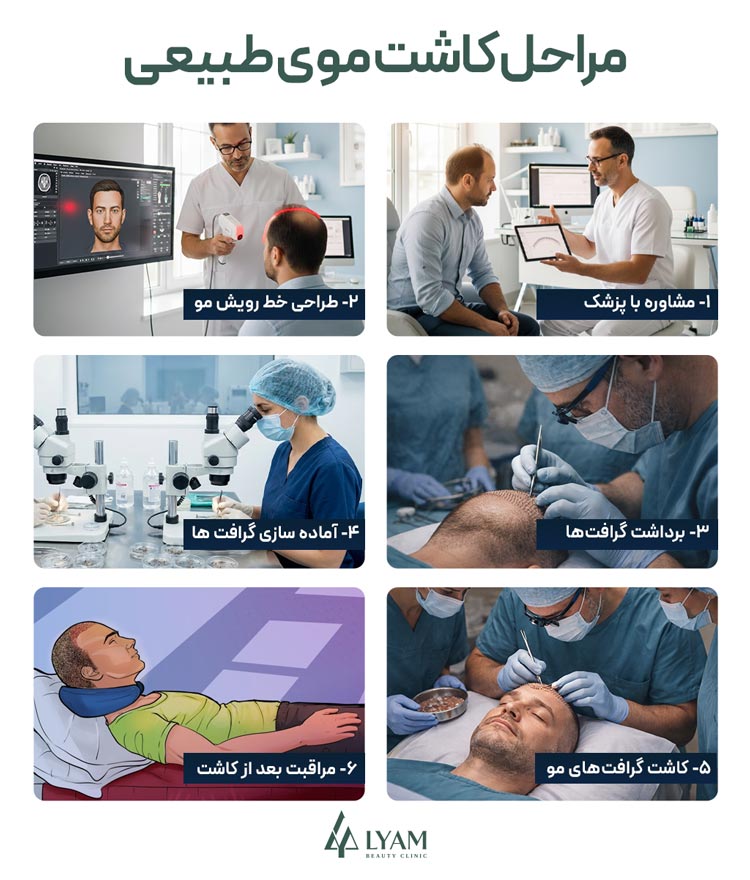 مراحل کاشت موی طبیعی