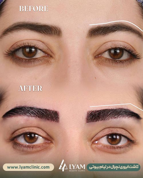 نتیجه کاشت ابروی طبیعی