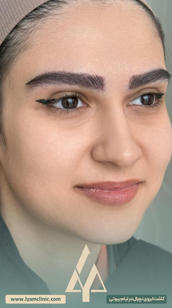 نتیجه کاشت ابرو طبیعی با تراکم بالا و فرم متقارن
