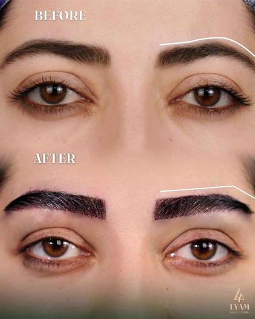 نتیجه کاشت ابروی طبیعی