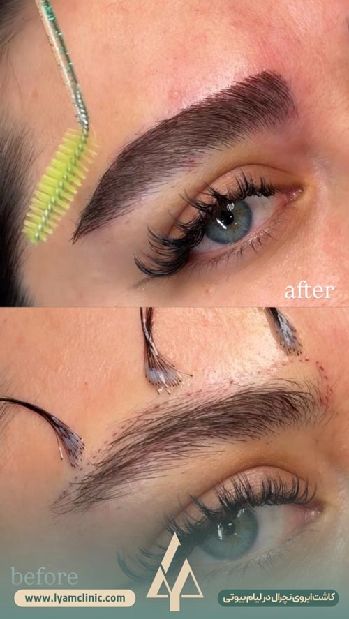 کاشت ابروی نچرال