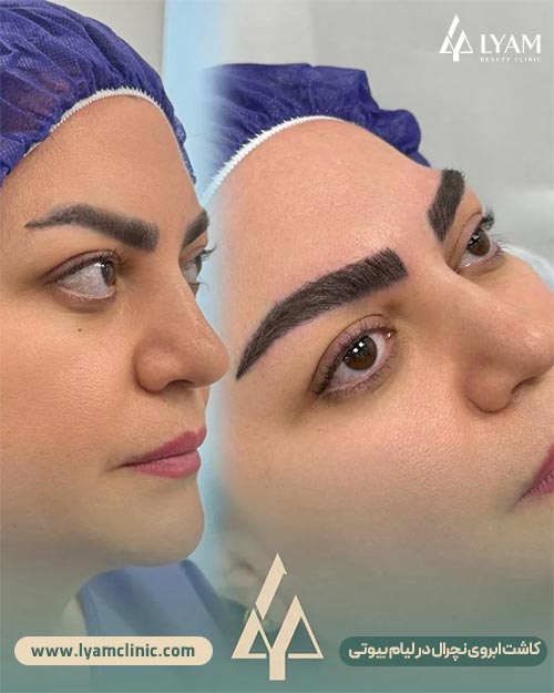 نتیجه نهایی کاشت ابروی طبیعی