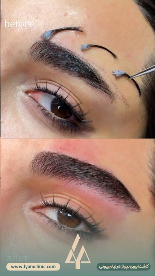 نتیجه کاشت ابروی نچرال