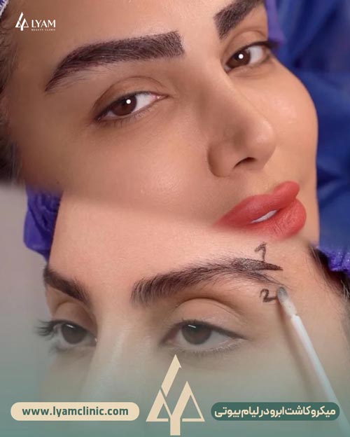 نتیجه کاشت ابرو در کلینیک زیبایی لیام