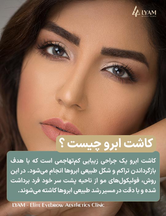 کاشت ابرو چیست ؟