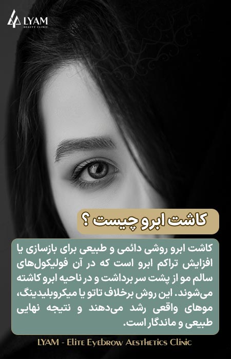 کاشت ابرو چیست؟