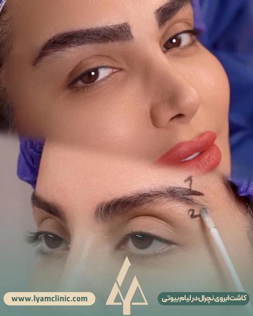 کاشت ابروی هایپرنچرال