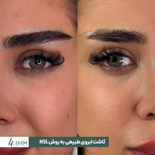 کاشت ابروی طبیعی با روش HSL