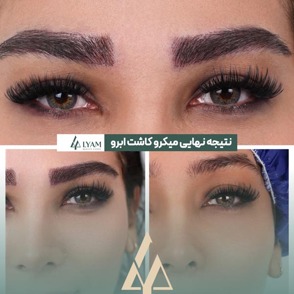 نتیجه نهایی کاشت ابرو