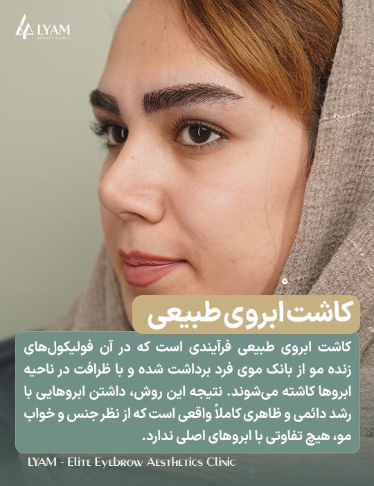 کاشت ابروی طبیعی چیست