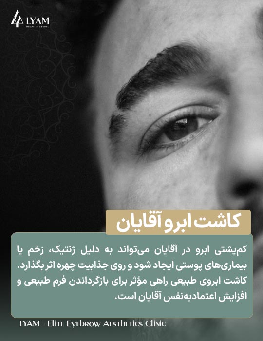 کاشت ابرو آقایان